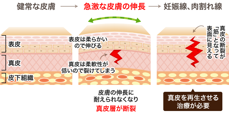 肉割れが起こる仕組み